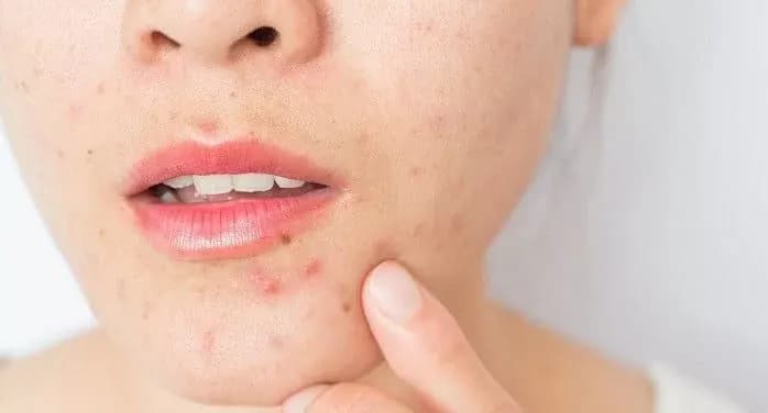 تفاوت آکنه های کبدی و هورمونی
