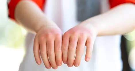 علائم پوستی رماتیسم