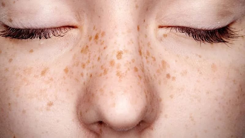لک های ناشی از آفتاب