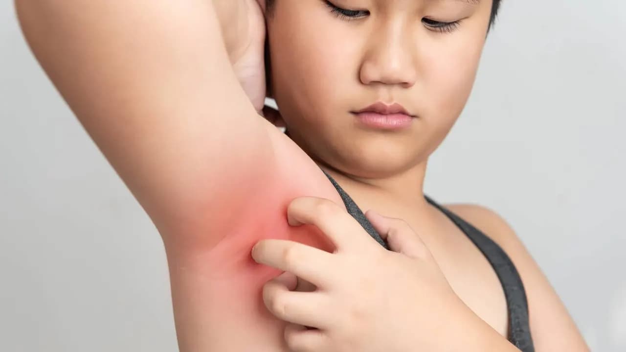 قارچ زیر بغل چیست و چگونه درمانش کنیم؟