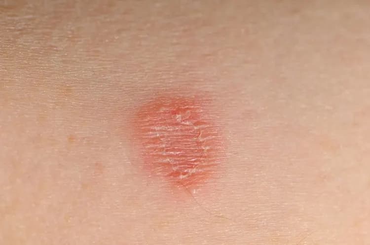 قارچ پوست صورت
