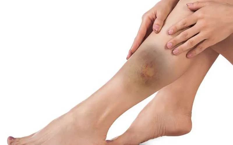 نکروز چیست؟