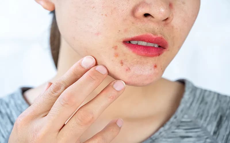 علت جوش چانه و گردن چیست؟