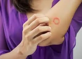 قارچ پوستی چیست و چگونه درمان می شود؟