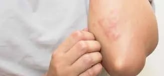 مشکلات پوستی مبتلایان به اچ آی وی