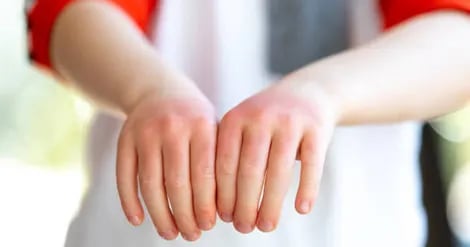 علائم پوستی رماتیسم