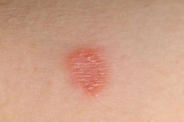 قارچ پوست صورت