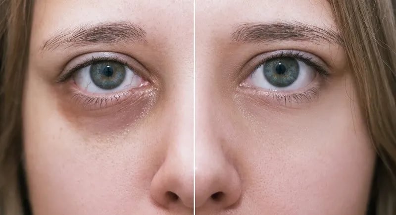 تزریق فیلر برای سیاهی دور چشم