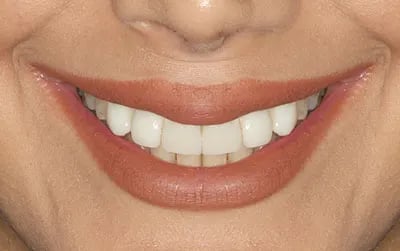 بوتاکس دیستون لبخند لثه‌ای