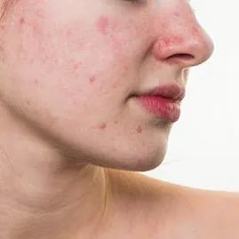 جوش های هورمونی