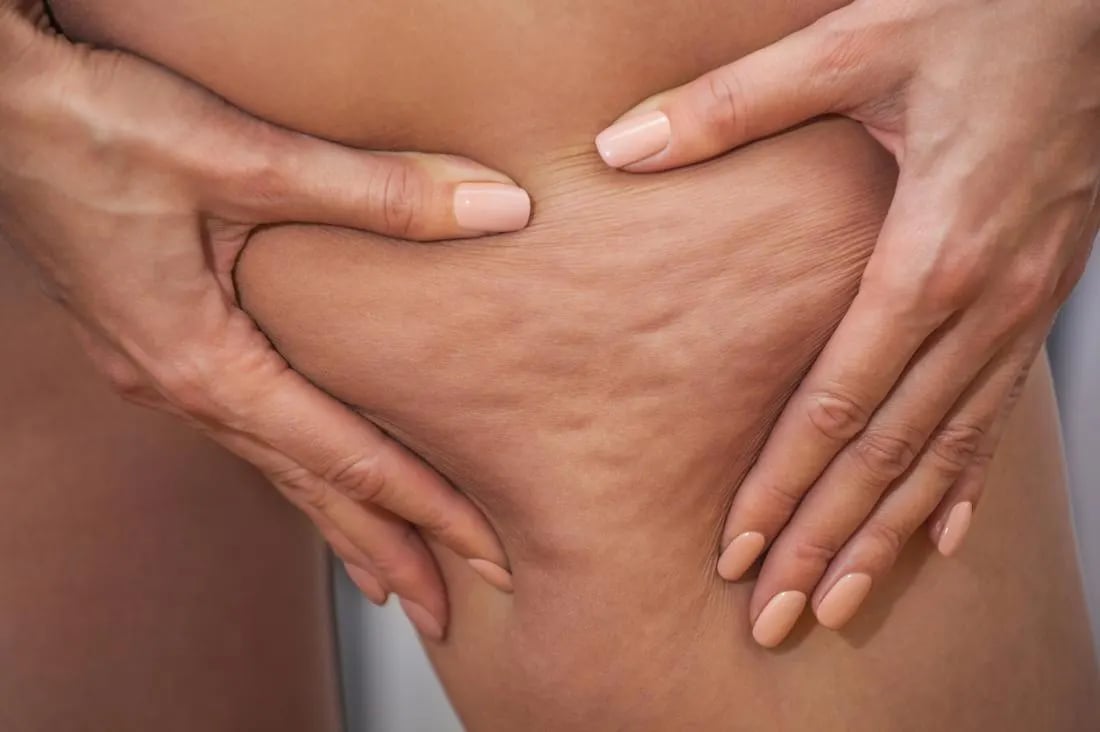 سلولیت Cellulite