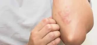مشکلات پوستی مبتلایان به اچ آی وی