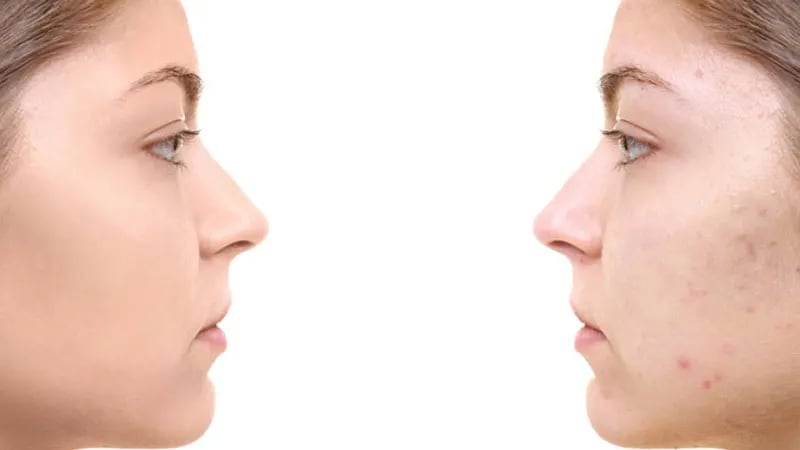 تفاوت سابسیژن با میکرونیدلینگ