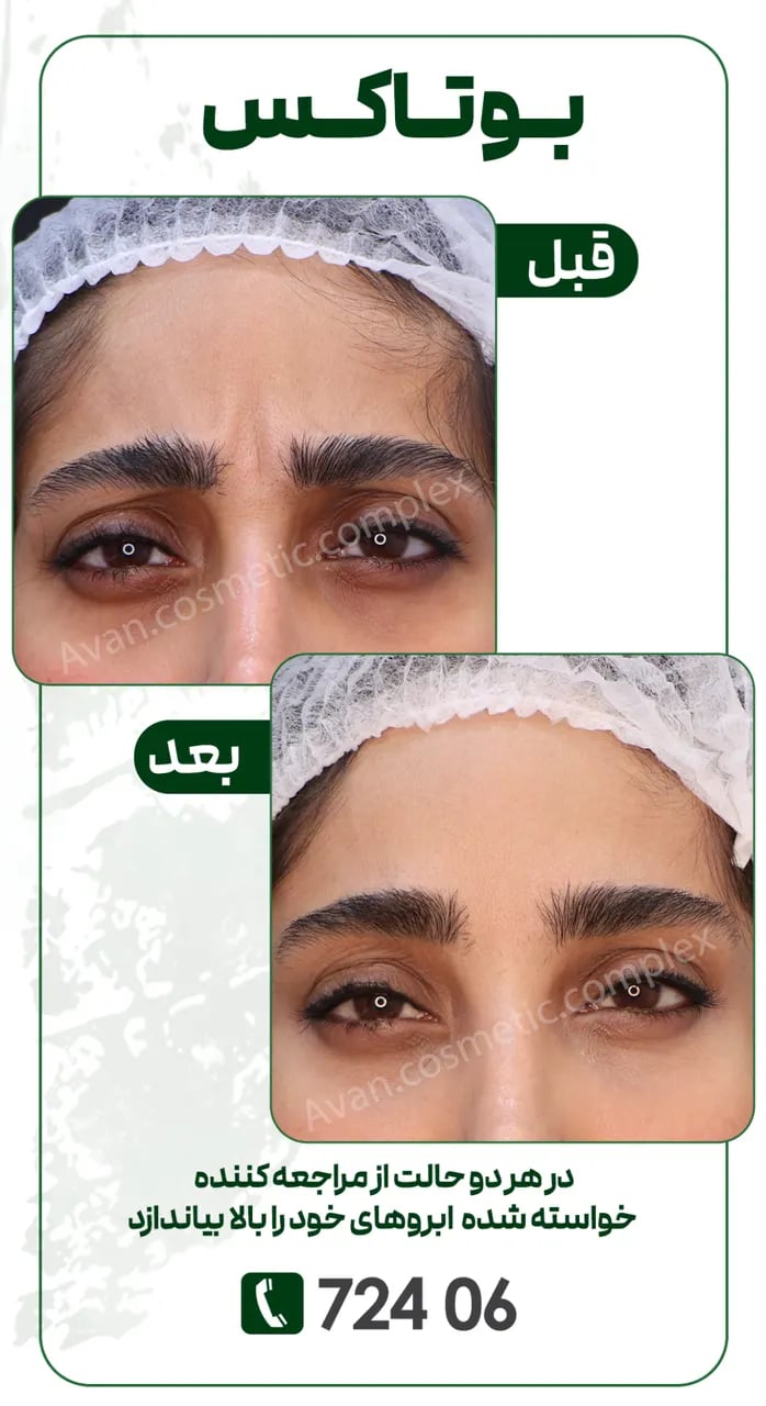 چرا اثر بوتاکس زود میره؟