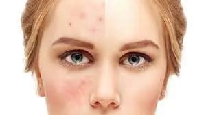 رفع لک های صورت با لیزر