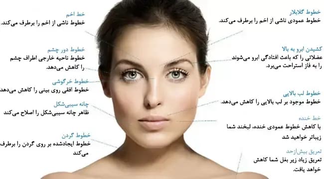 سوالات رایج در مورد بوتاکس