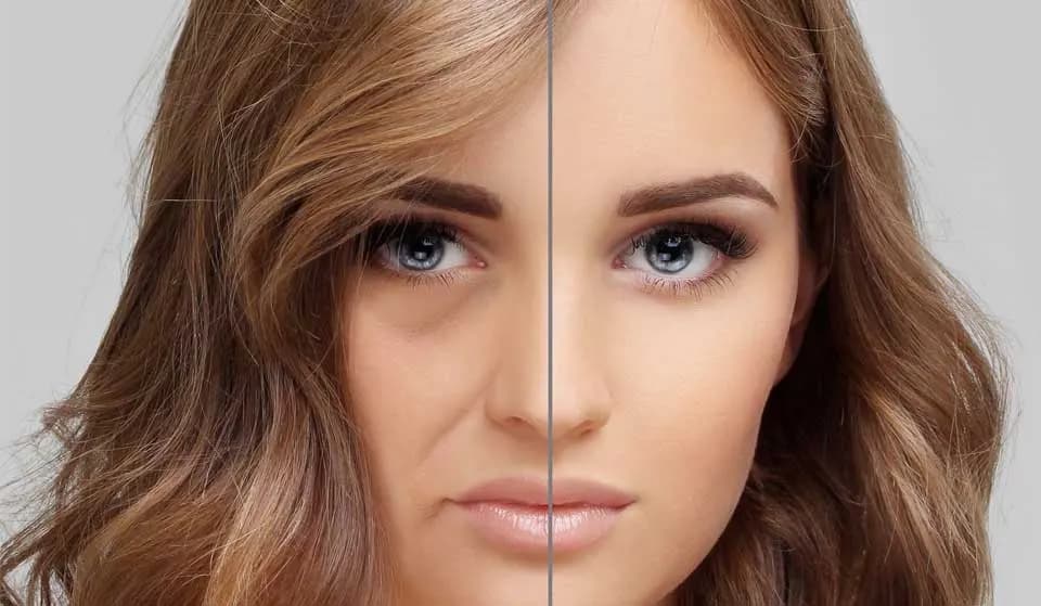 تزریق میدفیس
