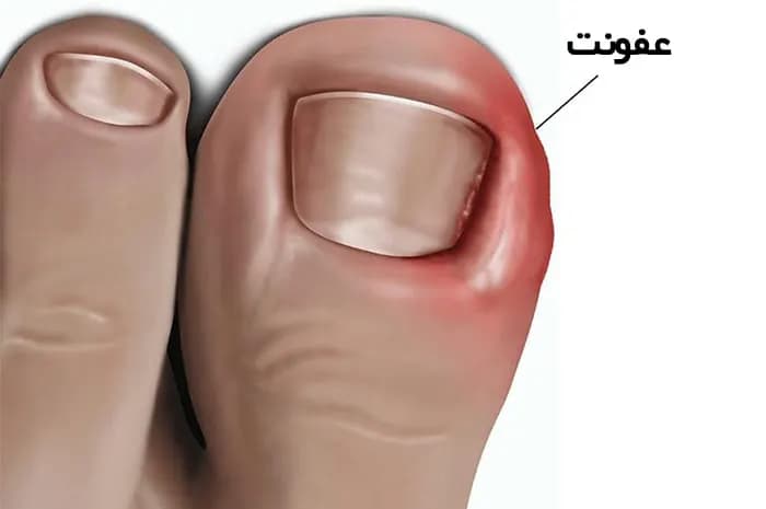 فرورفتن ناخن در گوشت