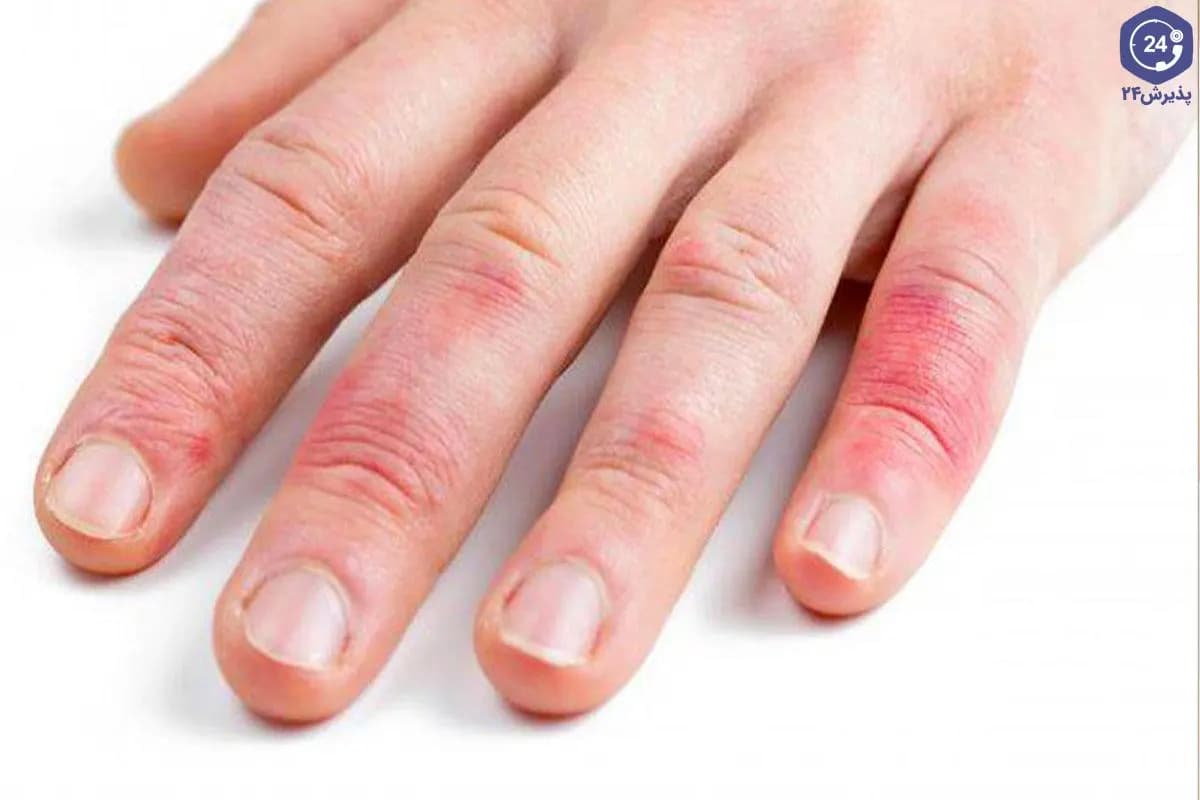 حساسیت به لاتکس