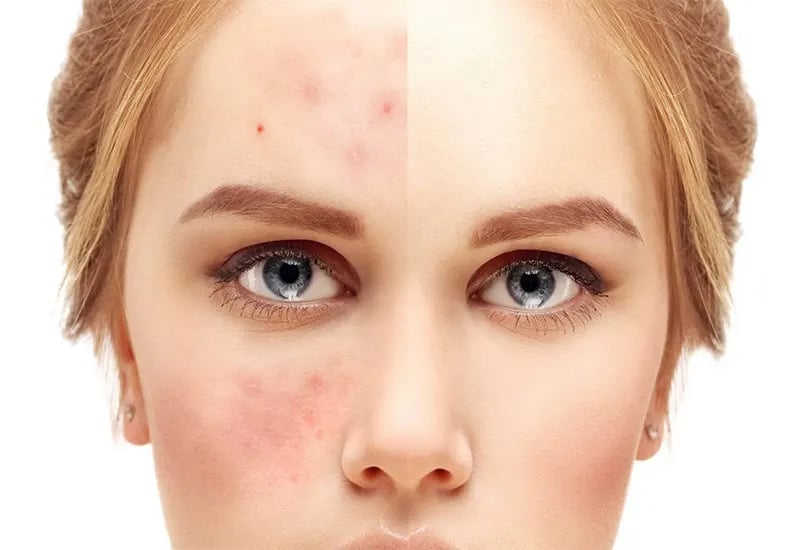 دلایل ایجاد جای جوش