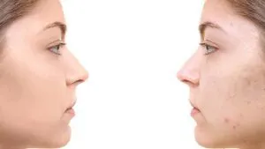 تفاوت سابسیژن با میکرونیدلینگ