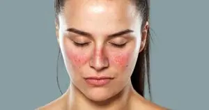 علائم پوستی رماتیسم