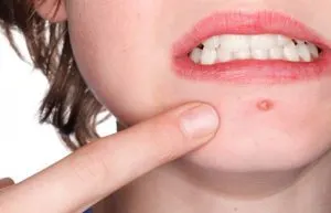 جوش های چرکی