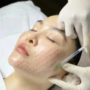 مزوتراپی mccm