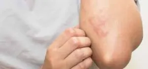 مشکلات پوستی مبتلایان به اچ آی وی