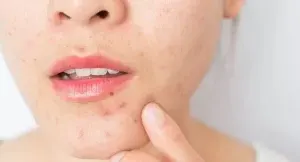 تفاوت آکنه های کبدی و هورمونی