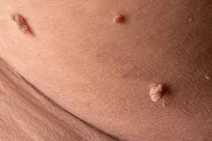 تفاوت گوشت اضافی و زگیل