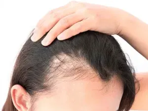 تاثیر استرس و بیماری کرونا روی ریزش مو