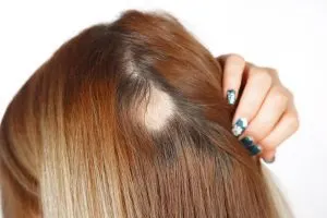 تاثیر استرس و بیماری کرونا روی ریزش مو