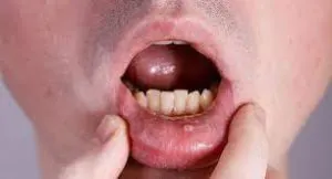 موکوسل