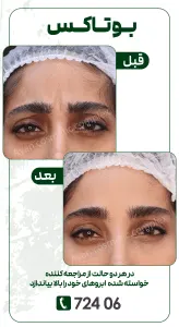 چرا اثر بوتاکس زود میره؟