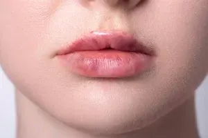 تزریق فیلر لب