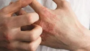 نمونه برداری از ضایعات پوستی