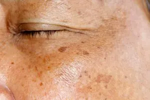 کراتوز سبورئیک