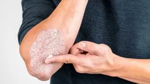 تفاوت پسوریازیس با اگزما