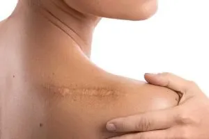 دکتر میراشه و درمان جای زخم