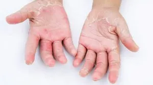  حساسیت به لاتکس 
