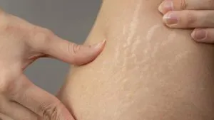 مشکلات پوستی بعد از لاغری