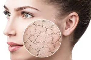 تفاوت پوست خشک و دهیدراته