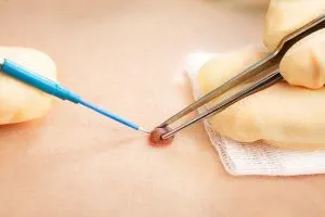 علت برگشت خال بعد از سوزاندن
