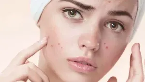 جوش های مقاوم به درمان 