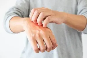 حساسیت پوستی به گل و گیاه