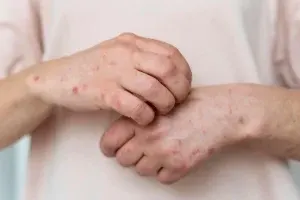 بیماری درماتومیوزیت