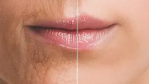 چین و چروک دور لب