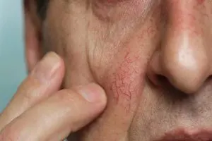 رگ های عنکبوتی