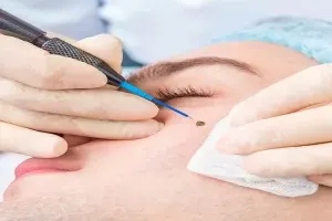 برداشتن خال با لیزر